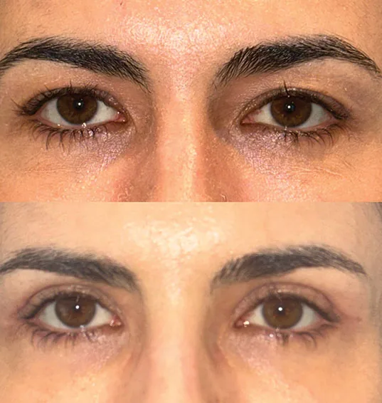 Pálpebras antes e depois da blefaroplastia