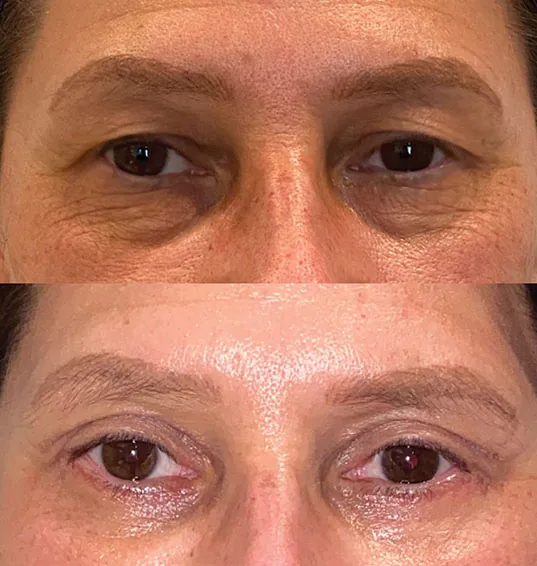 Pálpebras antes e depois da blefaroplastia